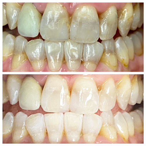 before and after teeth whitening in matthews, nc