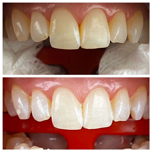 before and after teeth whitening in matthews, nc