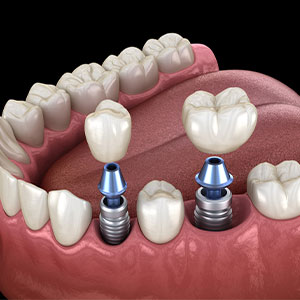 dental implants 3-D rendering in Matthews, NC